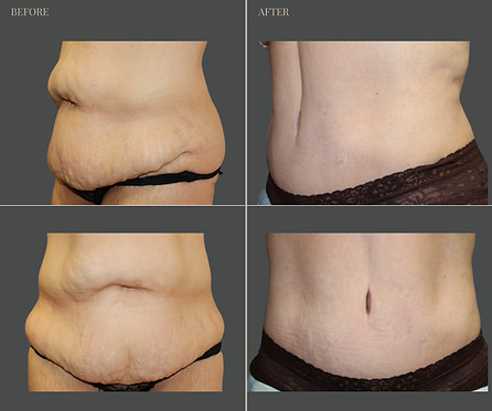 Tummy Tuck with Rau Plastic Surgery — before & after result