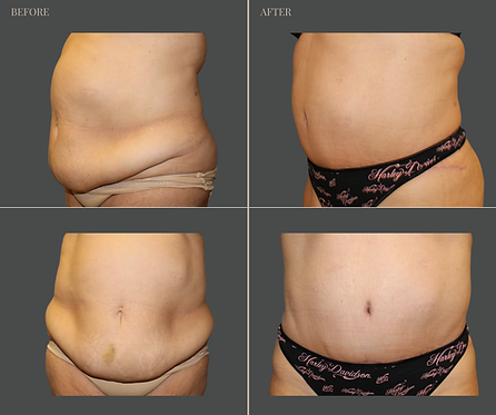 Tummy Tuck with Rau Plastic Surgery — before & after result