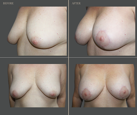 Breast Augmentation at Rau Plastic Surgery — before & after result