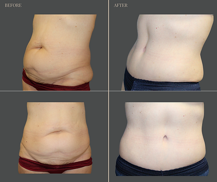 Tummy Tuck with Rau Plastic Surgery — before & after result