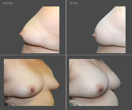 Breast Augmentation at Rau Plastic Surgery — before & after result