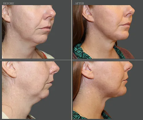 Natural — before & after result