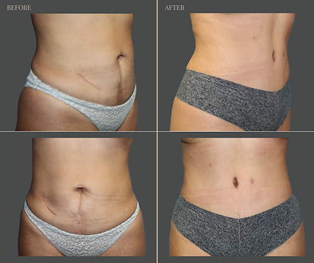 Tummy Tuck with Rau Plastic Surgery — before & after result