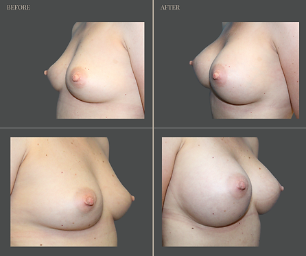 Breast Augmentation at Rau Plastic Surgery — before & after result