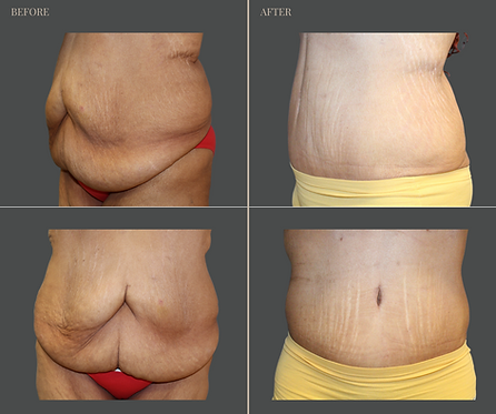 Tummy Tuck with Rau Plastic Surgery — before & after result