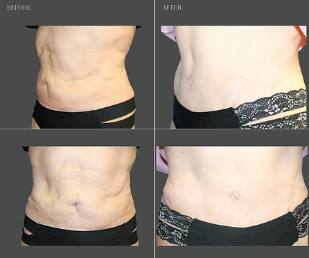 Tummy Tuck with Rau Plastic Surgery — before & after result