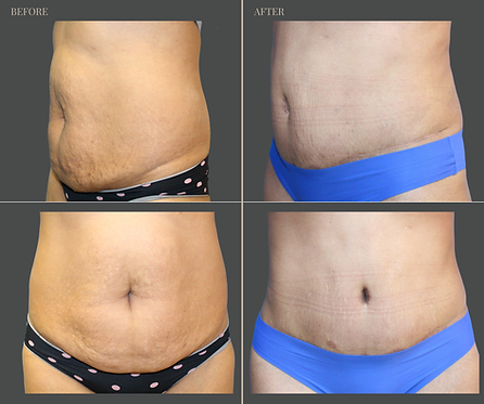 Tummy Tuck with Rau Plastic Surgery — before & after result