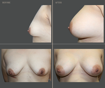 Breast Augmentation at Rau Plastic Surgery — before & after result