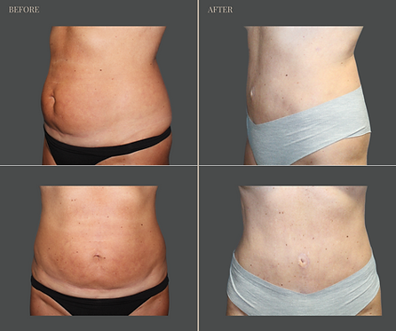 Tummy Tuck with Rau Plastic Surgery — before & after result