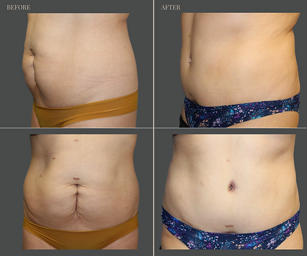 Tummy Tuck with Rau Plastic Surgery — before & after result