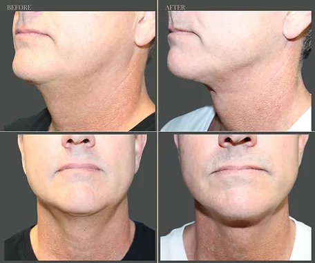 Natural — before & after result