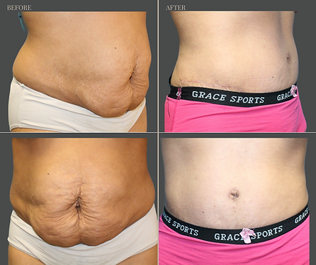Tummy Tuck with Rau Plastic Surgery — before & after result