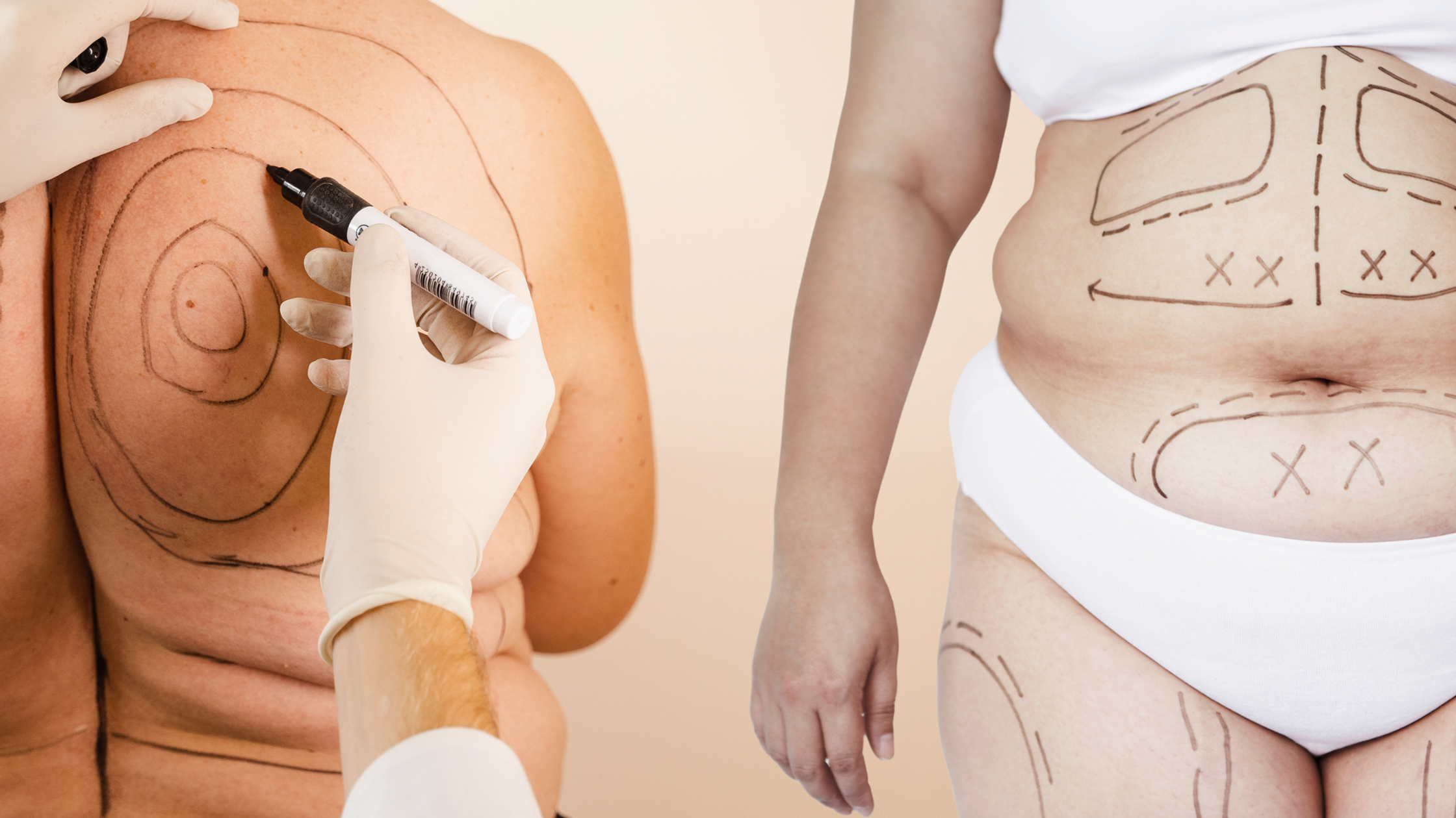 Liposuction Benefits: Boost Your Weight Loss Results