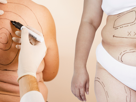 Liposuction: Enhancing Your Weight Loss Results