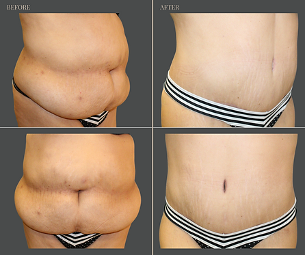 Tummy Tuck with Rau Plastic Surgery — before & after result