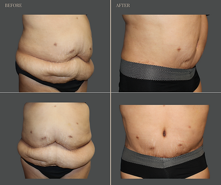 Tummy Tuck with Rau Plastic Surgery — before & after result