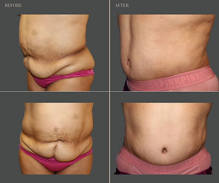 Tummy Tuck with Rau Plastic Surgery — before & after result