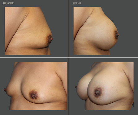 Breast Augmentation at Rau Plastic Surgery — before & after result