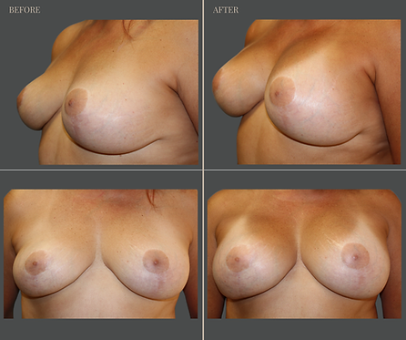 Breast Augmentation at Rau Plastic Surgery — before & after result