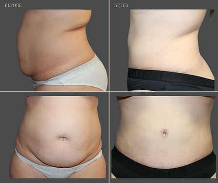 Tummy Tuck with Rau Plastic Surgery — before & after result