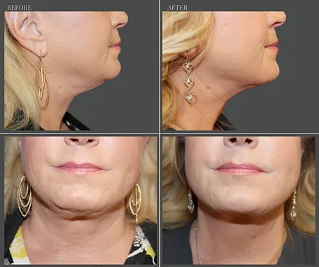Natural — before & after result