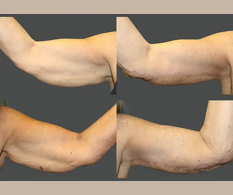 Get More Contoured Arms with Rau Plastic Surgery — before & after result