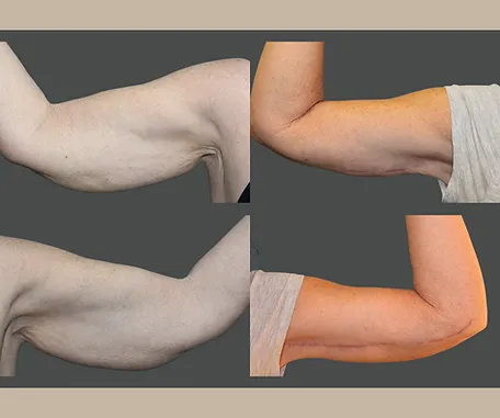 Get More Contoured Arms with Rau Plastic Surgery — before & after result