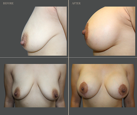 Breast Augmentation at Rau Plastic Surgery — before & after result