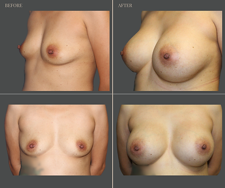 Breast Augmentation at Rau Plastic Surgery — before & after result