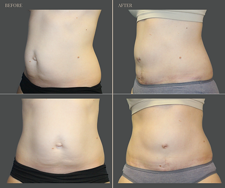 Tummy Tuck with Rau Plastic Surgery — before & after result