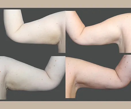 Get More Contoured Arms with Rau Plastic Surgery — before & after result