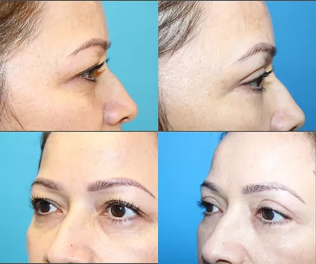 Eyelid Surgery with Rau Plastic Surgery — before & after result