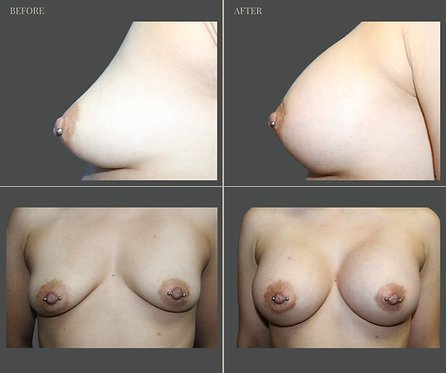 Breast Augmentation at Rau Plastic Surgery — before & after result