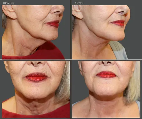 Natural — before & after result