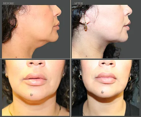 Natural — before & after result