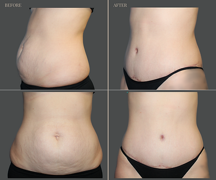 Tummy Tuck with Rau Plastic Surgery — before & after result