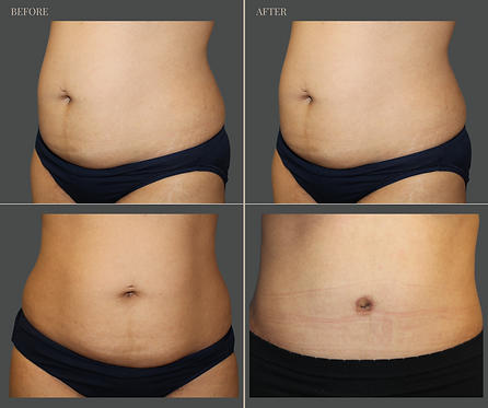 Tummy Tuck with Rau Plastic Surgery — before & after result