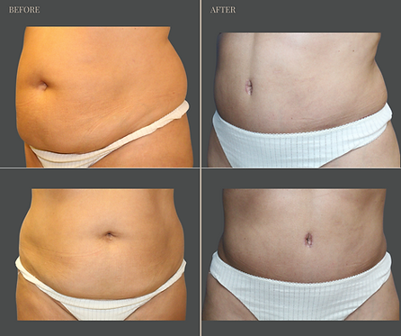 Tummy Tuck with Rau Plastic Surgery — before & after result