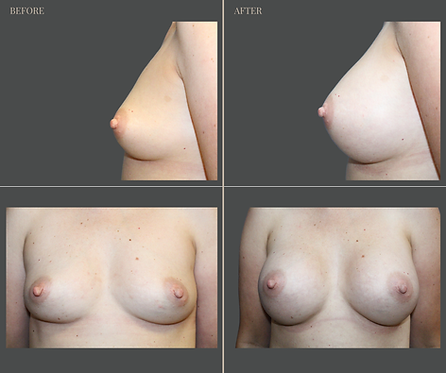 Breast Augmentation at Rau Plastic Surgery — before & after result