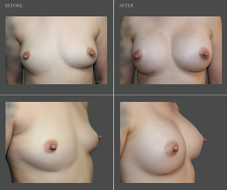 Breast Augmentation at Rau Plastic Surgery — before & after result
