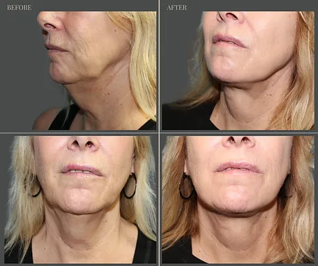 Natural — before & after result