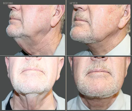 Natural — before & after result