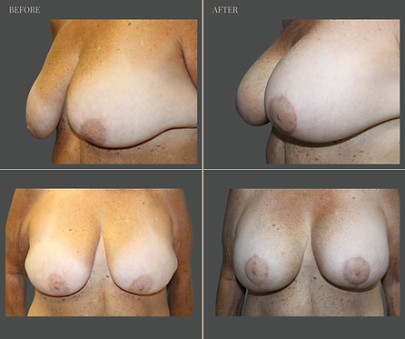 Breast Augmentation at Rau Plastic Surgery — before & after result