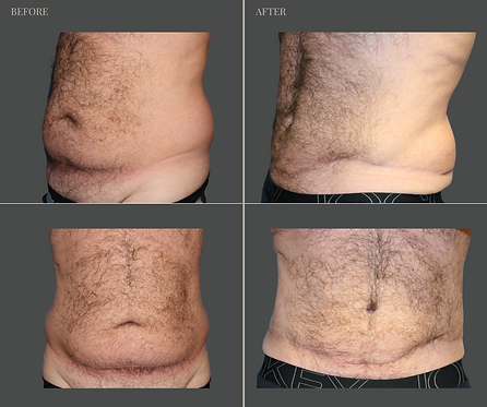 Tummy Tuck with Rau Plastic Surgery — before & after result