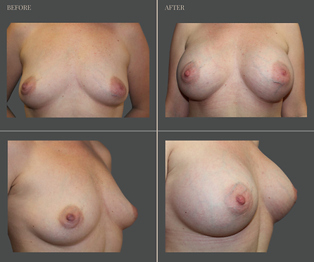 Breast Augmentation at Rau Plastic Surgery — before & after result