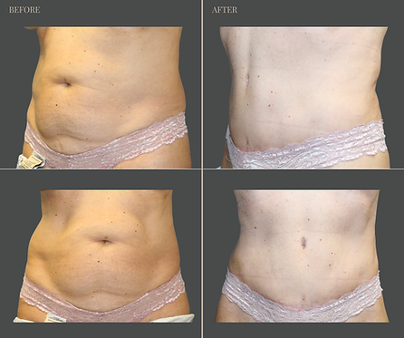 Tummy Tuck with Rau Plastic Surgery — before & after result