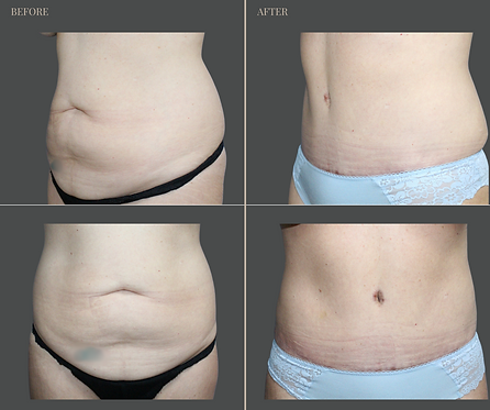Tummy Tuck with Rau Plastic Surgery — before & after result