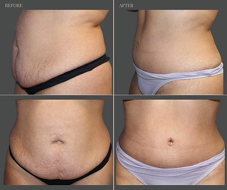 Tummy Tuck with Rau Plastic Surgery — before & after result