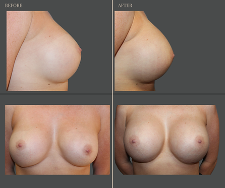Breast Augmentation at Rau Plastic Surgery — before & after result