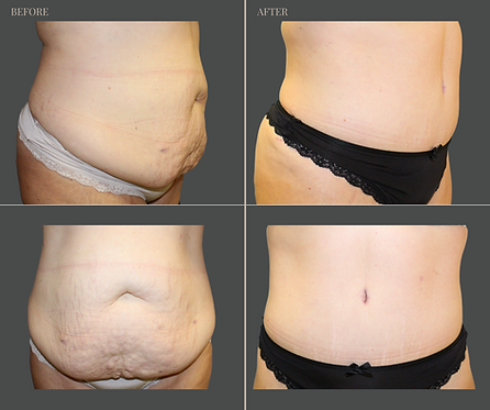 Tummy Tuck with Rau Plastic Surgery — before & after result